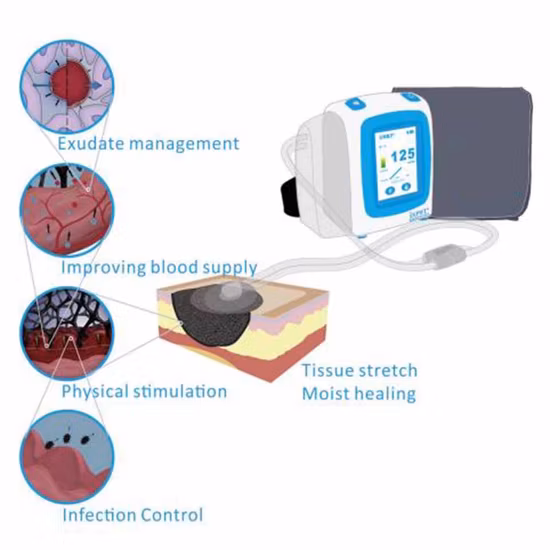Bluenjoy Hot Selling Npwt Dressing Kits Negative Pressure Wound Therapy Wound Drainage System